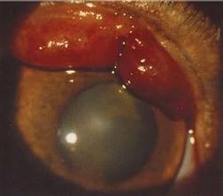 Кровоизлияния в глазное яблоко