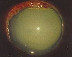 Острый приступ офтальмогипертензии и глаукома